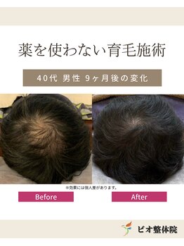 コレア整体院(COREA整体院)/ 再生育毛促進術