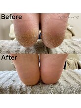 エレメントエヌ(Element N)/フットケア