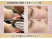 エステティック レイビス 青森店(RAYVIS)の雰囲気（【人気No1】今から夏に向けて脱毛をスタート！全身ツルスベに♪）