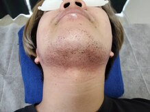 ネクストプラス 大分別府店(NEXT+)/【ヒゲ脱毛】施術