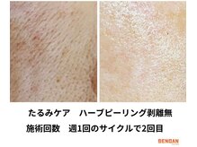 センガン(SENGAN)/たるみケア　剥離無