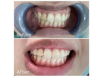 ウルト(ULT)/セルフホワイトニング