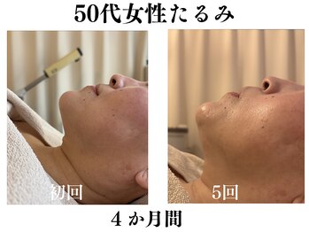 ランティル(l’until)の写真/たるみ/フェイスライン/アゴ下もたつきに/脂肪分解剤と小顔リフトアップマッサージでお顔一回り小さく！