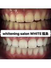 ホワイトニングサロン ホワイト(WHITE)/セルフホワイトニング効果