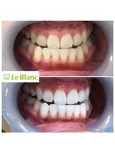 ルブラン 奈良店(Le Blanc)/見違える白さに！！