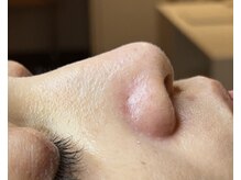 ストック(stock)/毛穴エクストラクション施術後