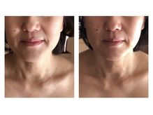 アフロディーテ(Aphrodite)/ほうれい線とフェイスライン