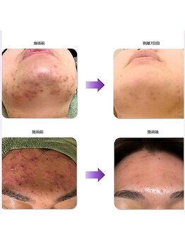 リズ ボーテ/本気で肌質改善ハーブピーリング