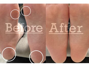 フィカスディボタニカ(FICUS di botanica)/足裏の角質除去