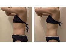 ルシエル ハカタ(Luciel HAKATA)/痩身120分×3回を1ヶ月(20代)