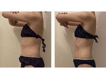 ルシエル ハカタ(Luciel HAKATA)/痩身120分×3回を1ヶ月(20代)