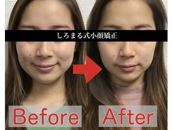 アベックトア(Avectoi)/顔がスッキリするだけで小顔!