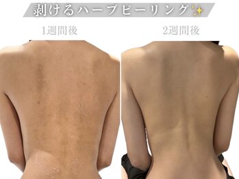 メイリリー 新宿(Meilily)/背中ケア☆ブライダル