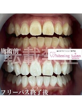 ホワイトニングサロン 福岡博多店/ホワイトニング
