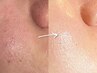 何をしても改善しないニキビ、毛穴にお悩みの方！【美肌育成フェイシャル】