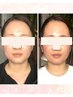 [食いしばり/エラ張り/顔筋疲労] 小顔調整コルギ～石膏パックなし～70分