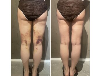 エッセンスビー 六本木の写真/「術後アフターケア◎」インディバで理想の仕上がりを叶える!完全個室サロンで安心プライベート◎