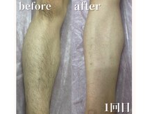 サロン ルーシュ(salon ruche)/脱毛(ひざ下)