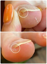 ネイルカフェ ナナ(nailcafe'nana)/フットトラブルケア