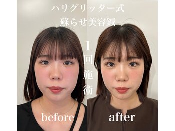鍼グリッター 岡山本院(鍼Glitter.)/【ビフォーアフター】美容鍼