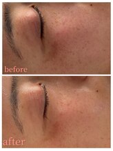 ミラビューティー(Mira Beauty)/シミケア×エクソソーム導入