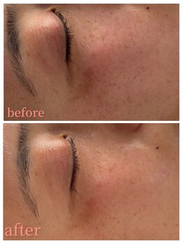 ミラビューティー(Mira Beauty)/シミケア×エクソソーム導入