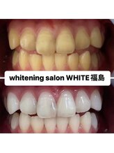 ホワイトニングサロン ホワイト(WHITE)/セルフホワイトニング効果