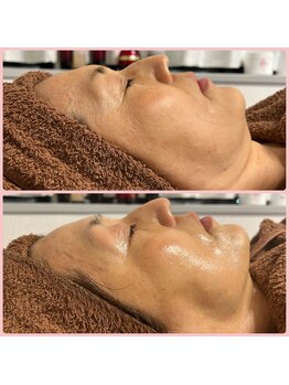 メリー(merry)/ハーブピーリング×小顔矯正◎