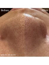 スキル アイラッシュ(SKILL eyelash)/ウォーターピーリング☆毛穴洗浄