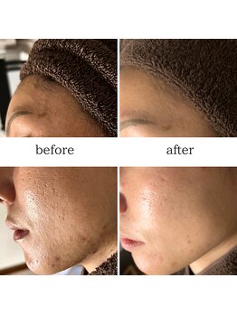 マーギアー(Magier)/ハーブピーリング初来店→６回目