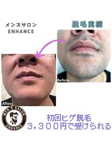 エンハンス 亀有(enhance)/脱毛実績