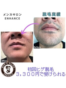 エンハンス 亀有(enhance)/脱毛実績