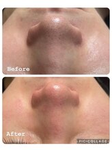 コンフィデンスサロン(Confidence Salon)/毛穴汚れもスッキリ！
