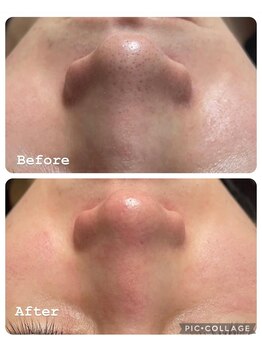 コンフィデンスサロン(Confidence Salon)/毛穴汚れもスッキリ！