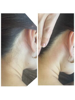 エンズ(O's)/うなじ脱毛