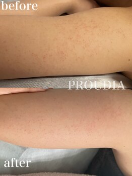 プラウディア(PROUDIA)/背中ニキビケア/体ハーブ/二の腕