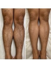 サロンドプッチイ(SalondoPutti)/【ハイブリッド】足脱毛