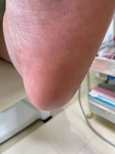 フットメンテ 巻き爪矯正センター 南浦和/肥厚した踵　施術後