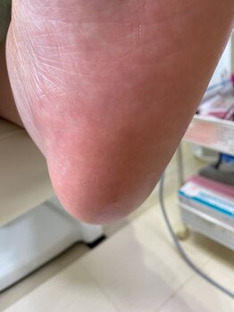 フットメンテ 巻き爪矯正センター 南浦和/肥厚した踵　施術後