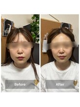 リノリー(rinory)/小顔矯正