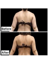 クールヴィラ(Cool Villa)/腕2カップはみ肉2カップ