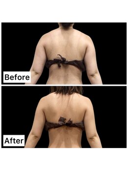 クールヴィラ(Cool Villa)/腕2カップはみ肉2カップ