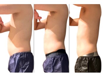 サロンドモフィ(salon de moffy)/痩身【脂肪冷却】おなか施術例５