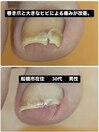 巻き爪・ヒビによる痛みが改善