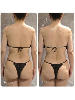 インディバ 六本木/【上半身集中】before→after