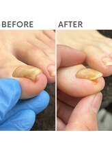 クオッカ(Quokka)/巻き爪ケア