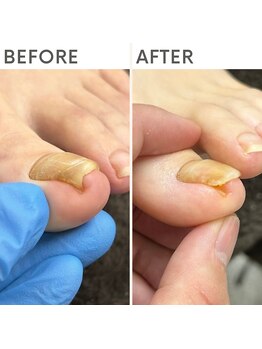 クオッカ(Quokka)/巻き爪ケア