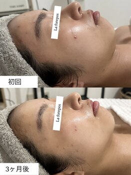 ラ フォルポ 恵比寿(La forepos)/veruna無農薬ハーブピーリング