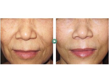 ハルリ(Haruri)/気になるほうれい線にも