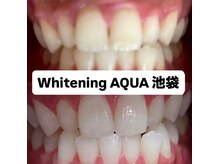 アクア 池袋店(AQUA)/ホワイトニング/池袋/東京/美白